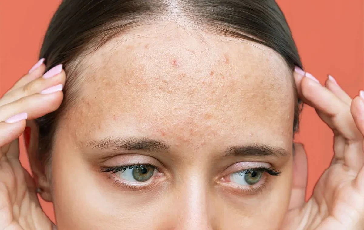 کرم ضد جوش درماتیپیک مدل intense حجم ۳۰ میلی لیتر